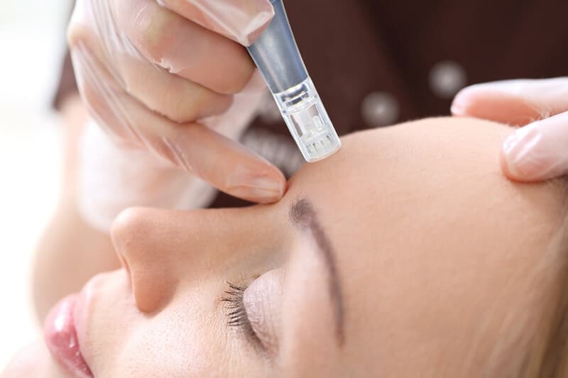 Microneedling: The Collagen-Boosting Facial Treatment You Need to Try