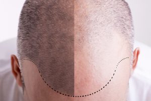 Reversing Hair Loss with PRP: How Platelet-Rich Plasma is Transforming Hair Restoration