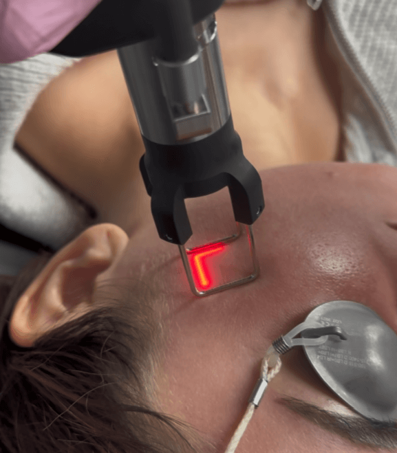 CoolPeel Laser: Say Goodbye to Wrinkles and Sun Damage with This