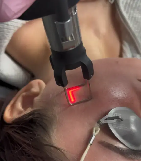 CoolPeel Laser: Skin Rejuvenation