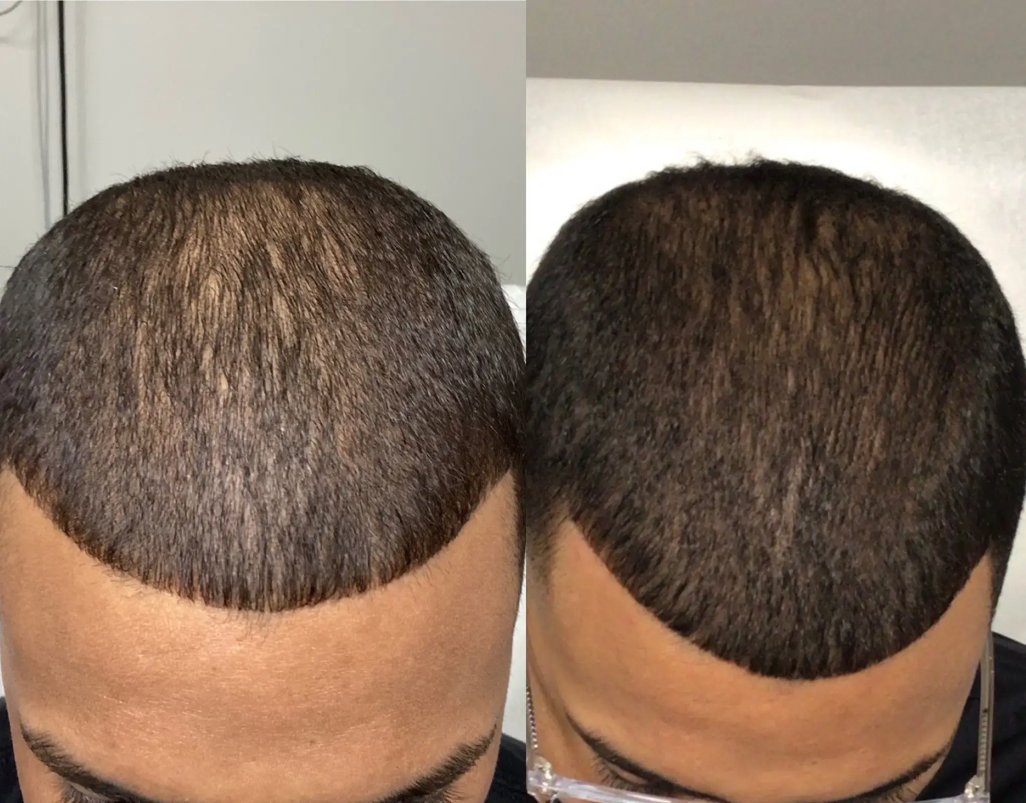 Healthier Hair: What Viviscal Pro Is and Why It Pairs Perfectly with PRP Hair Restoration